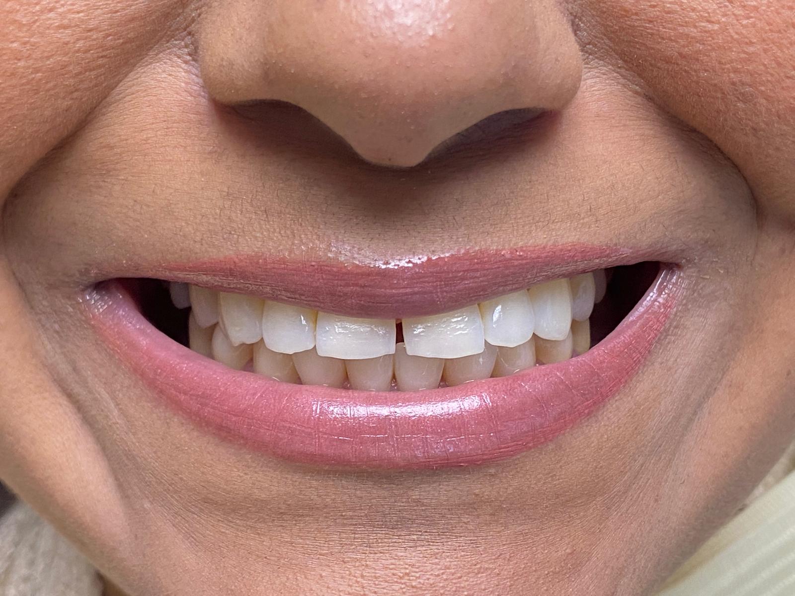 Misaligned teeth before